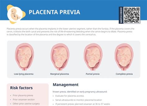 Schematické znázornenie placenty previa, odtrhnutia placenty a placenty accreta.