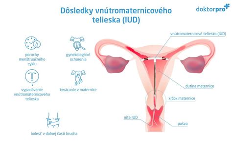 Ilustrácia zavedenia vnútromaternicového telieska