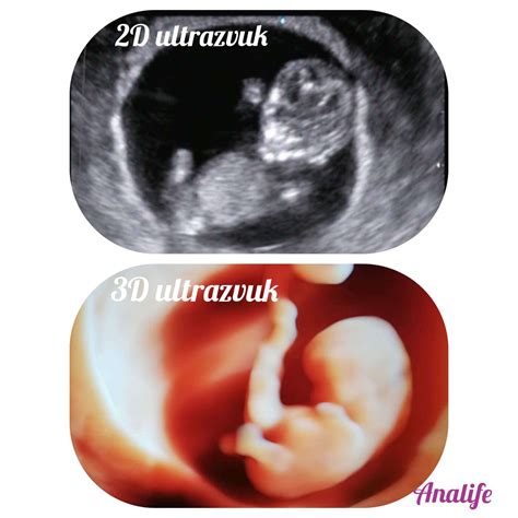 infografika porovnávajúca 2D, 3D a 4D ultrazvuk