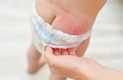 Obrázok detského zadočka s plienkovou dermatitídou a druhý obrázok zdravého zadočka