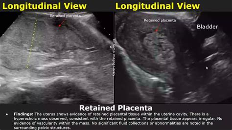 ultrazvukové zobrazenie placenty na prednej stene