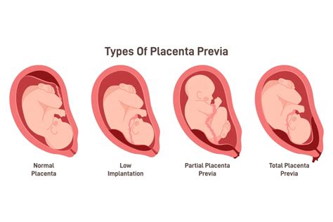 placenta previa vs normálne umiestnenie placenty