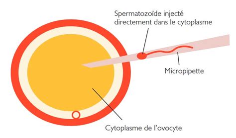 Schéma metódy ICSI