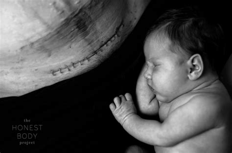 Vizualizácia hojenia jazvy po cisárskom reze