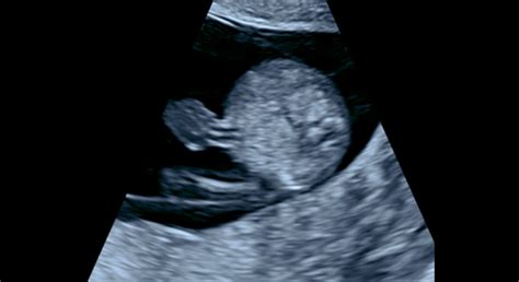 ultrazvukové vyšetrenie plodu v prvom trimestri