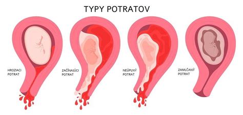 Príznaky spontánneho potratu