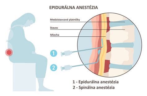 Schematické znázornenie aplikácie epidurálnej analgézie