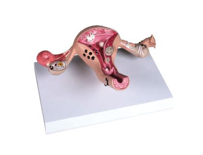 ilustrácia implantácie oplodneného vajíčka do steny maternice