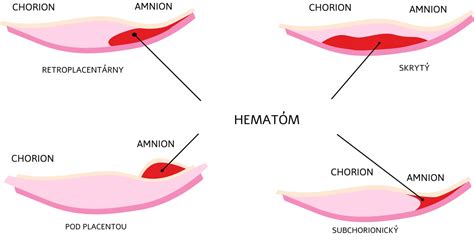 Štruktúra hematómu