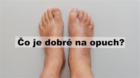 Infografika porovnávajúca bežný a nebezpečný opuch nôh