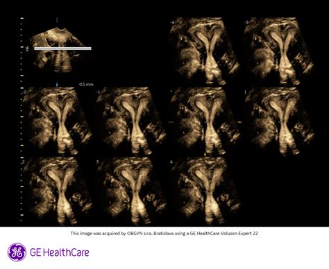 ultrazvukové vyšetrenie maternice po cisárskom reze