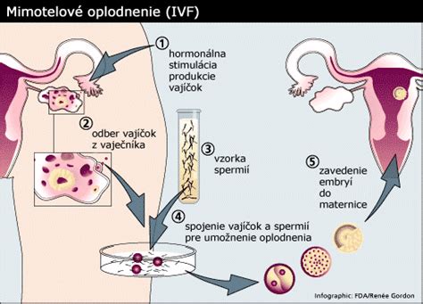 Tabuľka s prehľadom metód asistovanej reprodukcie a ich úspešnosťou