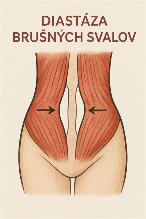 Test na diastázu brušných svalov