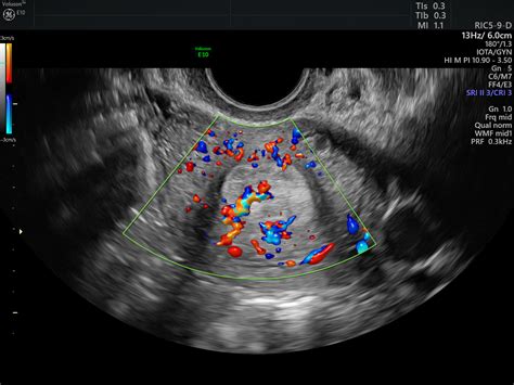 Ultrazvukové zobrazenie endometria