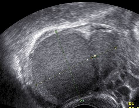 Priečny rez maternicou s vyznačeným endometriom a myometriom