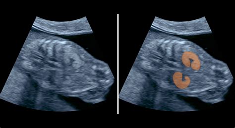 ultrazvuk v prvom trimestri