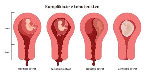 ikony symbolizujúce nebezpečné príznaky v tehotenstve