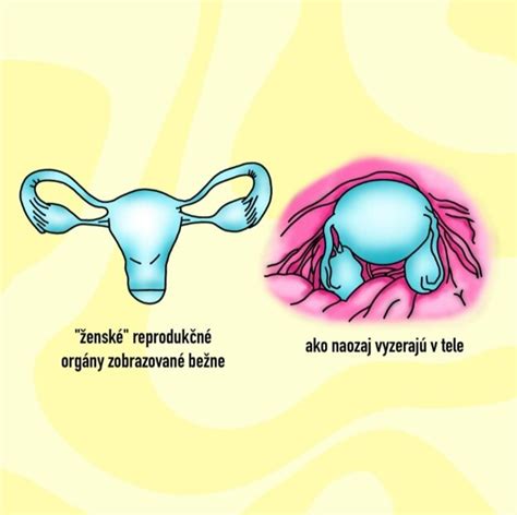 Mapa rozšírenia endometriózy v tele ženy