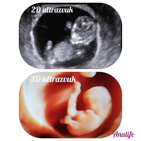 Schéma porovnania 2D, 3D a 4D ultrazvuku