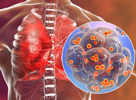 Ilustrácia vírusov a baktérií spôsobujúcich ochorenia dýchacích ciest