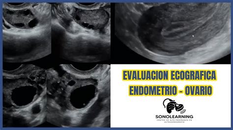 ultrazvukové zobrazenie endometria s trojvrstvovou štruktúrou