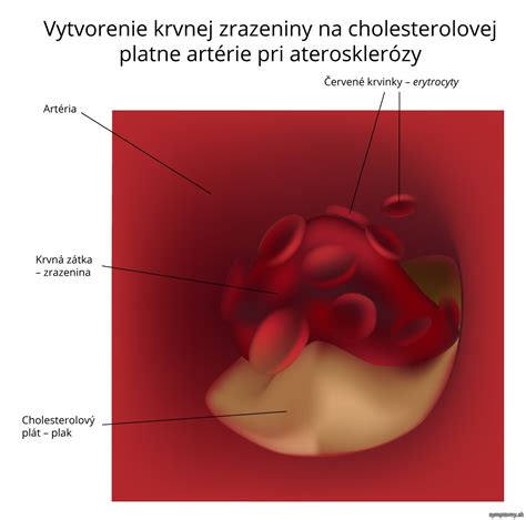Ilustrácia krvnej zrazeniny blokujúcej cievu