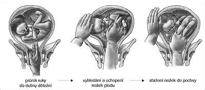 Externý obrat plodu