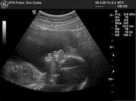 ultrazvuk plodu