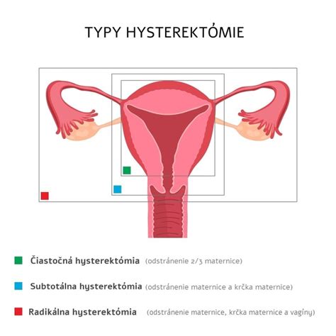 Schéma laparoskopickej hysterektómie