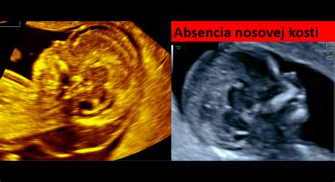 Ultraľukový snímok embrya v prvom trimestri