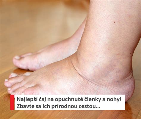 Ilustrácia opuchnutých nôh v tehotenstve