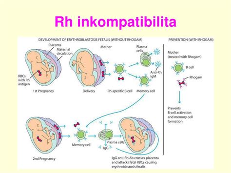Infografika: Rh inkompatibilita v tehotenstve