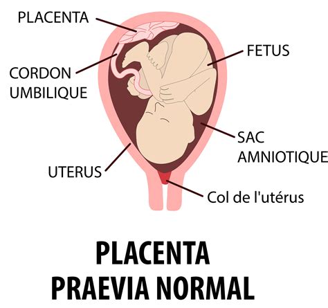 Schéma placenty praevia