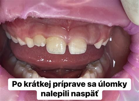 Ilustrácia mliečneho zuba, ktorý sa kýva