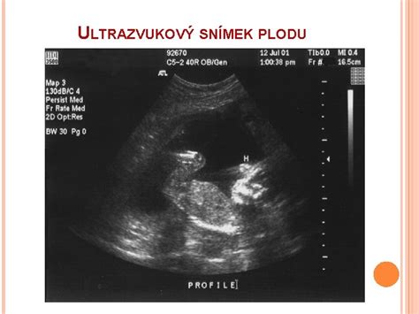 Ultrazvukový snímok plodu ukazujúci meranie NT