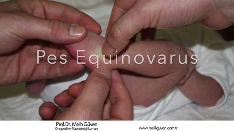 Pes equinovarus congenitus