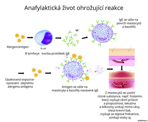 Ilustrácia príznakov anafylaktického šoku