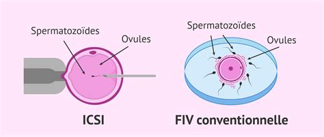 schéma IVF a ICSI