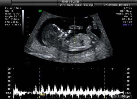 ultrazvuk bábätka v brušku