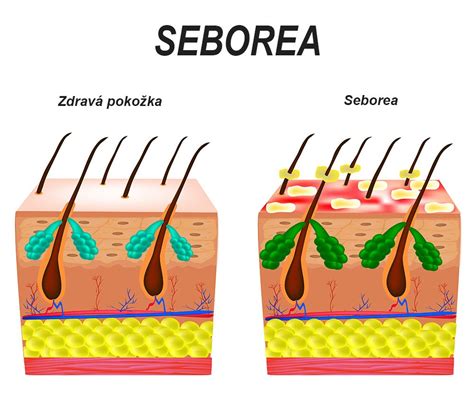 Porovnanie zdravej a ekzematickej pokožky