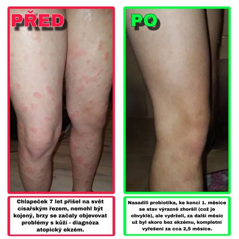 Ilustrácia atopického ekzému u dieťaťa