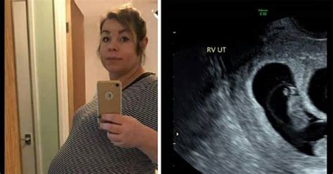 Ultrazvukový snímok zobrazujúci nízko položenú placentu