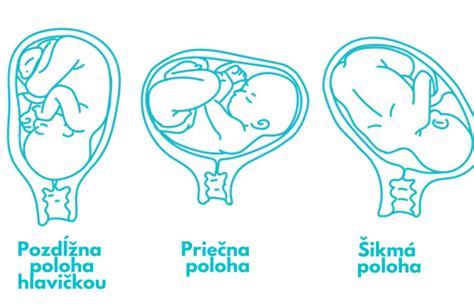 Ilustrácia rôznych polôh plodu v maternici