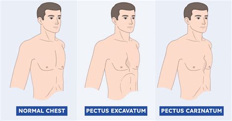 Porovnanie deformít hrudníka: Pectus excavatum a Pectus carinatum