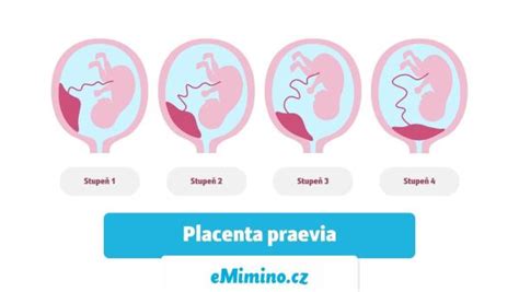 Schematické znázornenie nízko položenej placenty