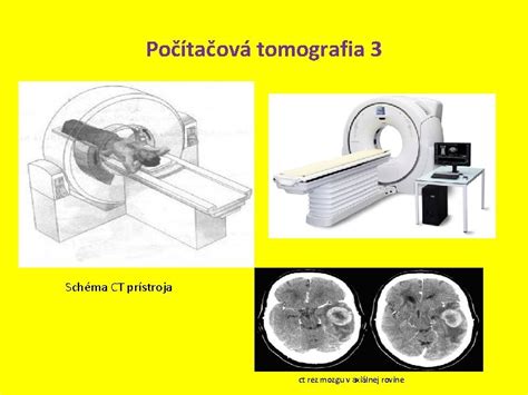 Schéma fungovania CT prístroja
