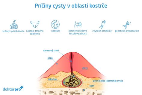 Ilustrácia cysty v prsníku
