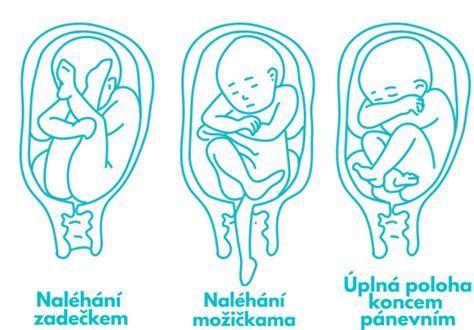 Ilustrácia polohy plodu hlavičkou nadol