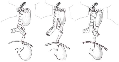 Schéma atrézie konečníka s fistulou