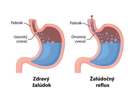 Ilustrácia správneho rektálneho podania diazepamu